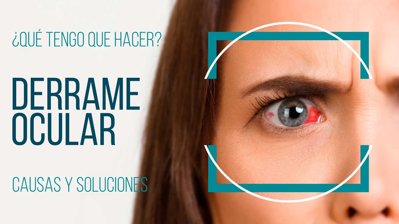 derrame en el ojo por estrés
