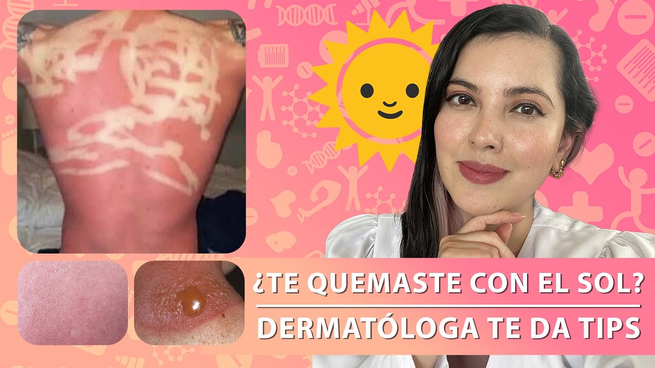 la nivea es buena para las quemaduras del sol