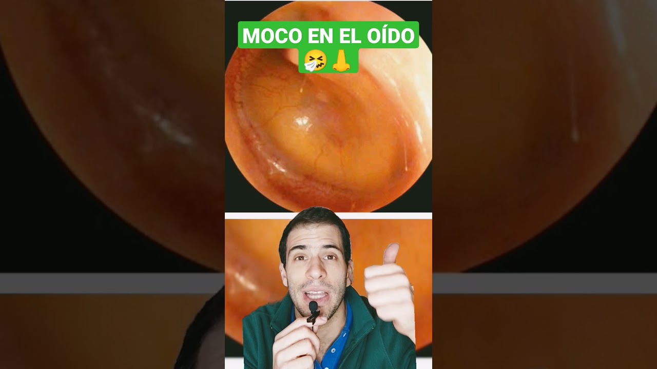 mocos en el oido