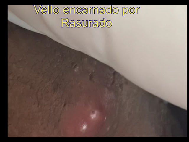 pelo enquistado ingle bulto