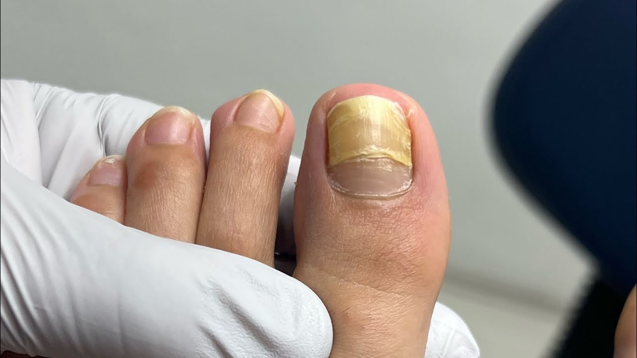 uña dedo gordo pie despegada