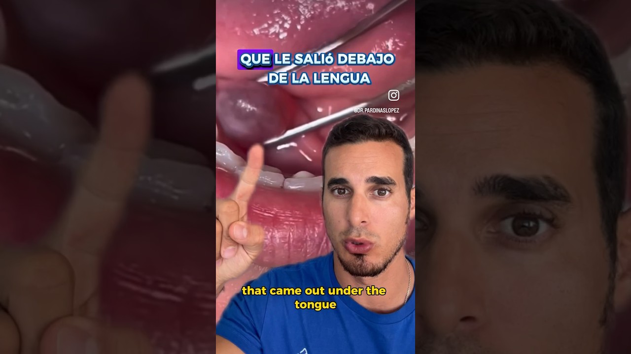 bulto en la lengua