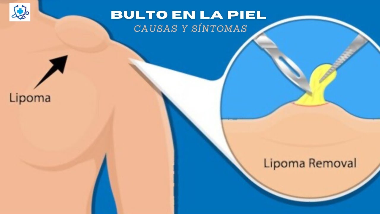 bulto en la piel rugoso y con forma redondeada