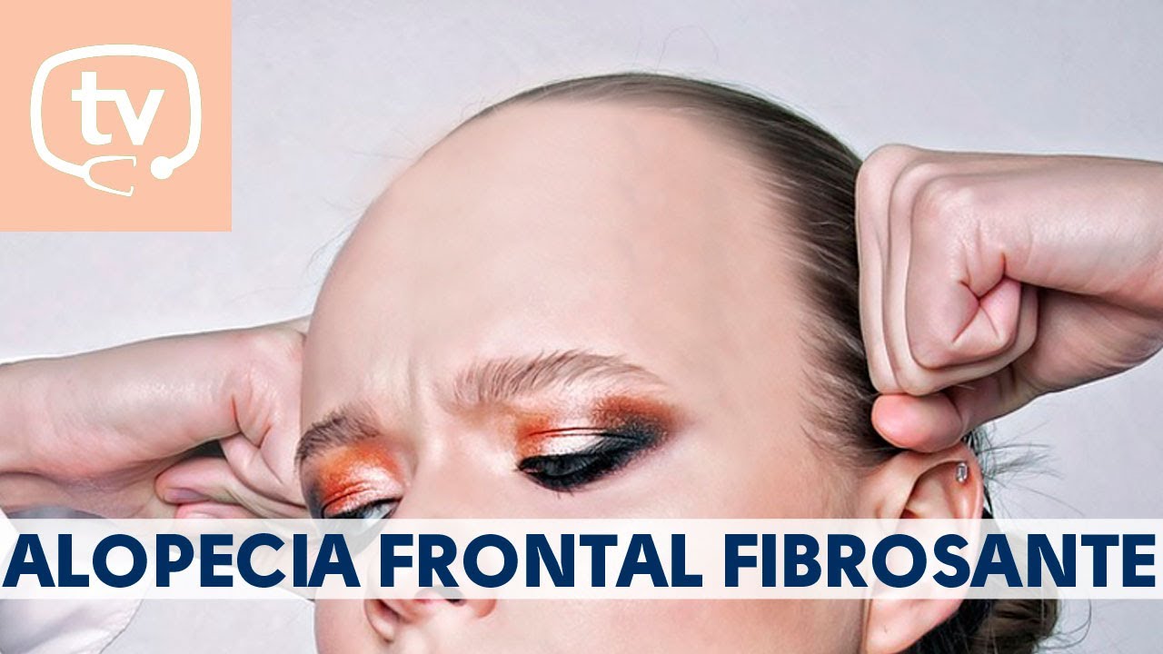 disimular alopecia frontal mujer