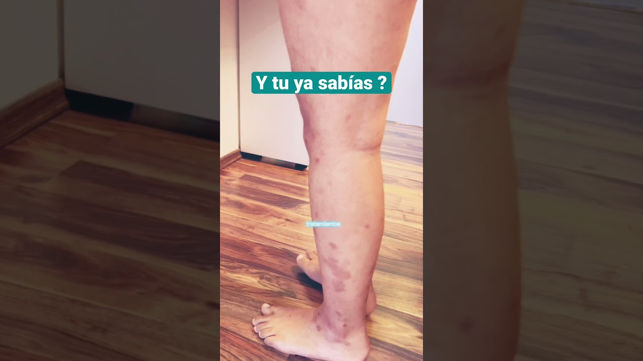 manchas rojas en las piernas