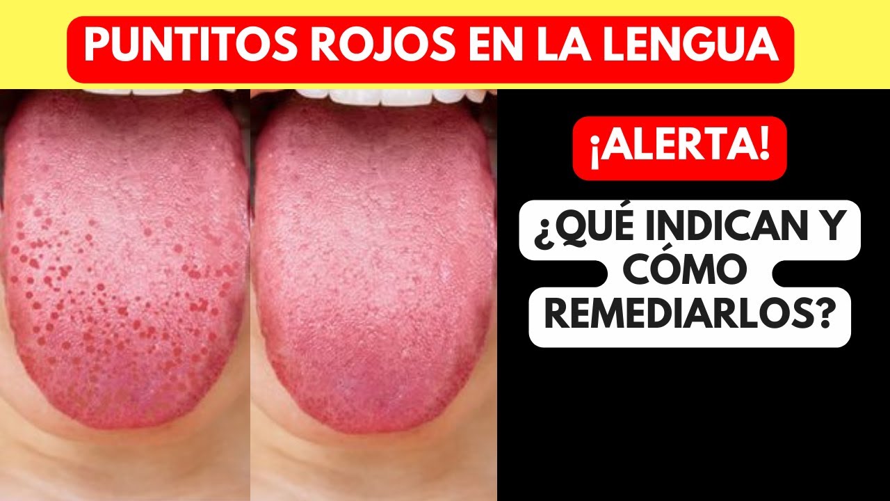 puntitos rojos en la lengua