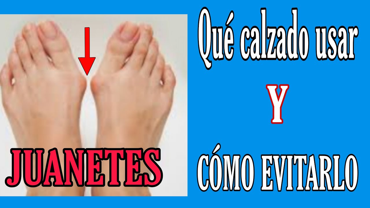 sandalias para disimular juanetes
