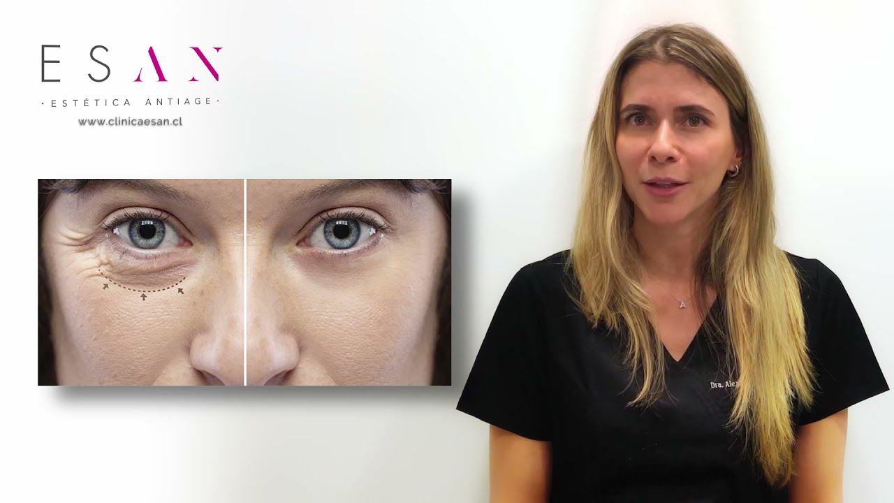 tratamiento ojeras antes y después