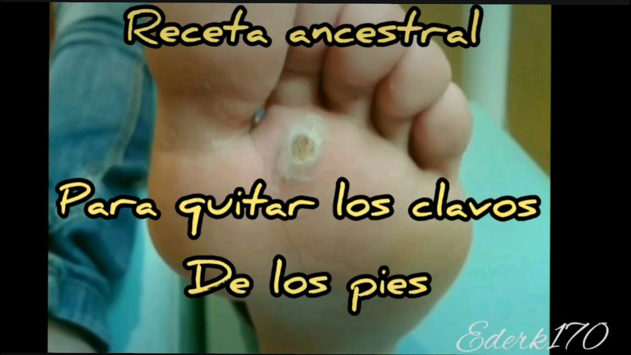 como quitar un heloma plantar en casa