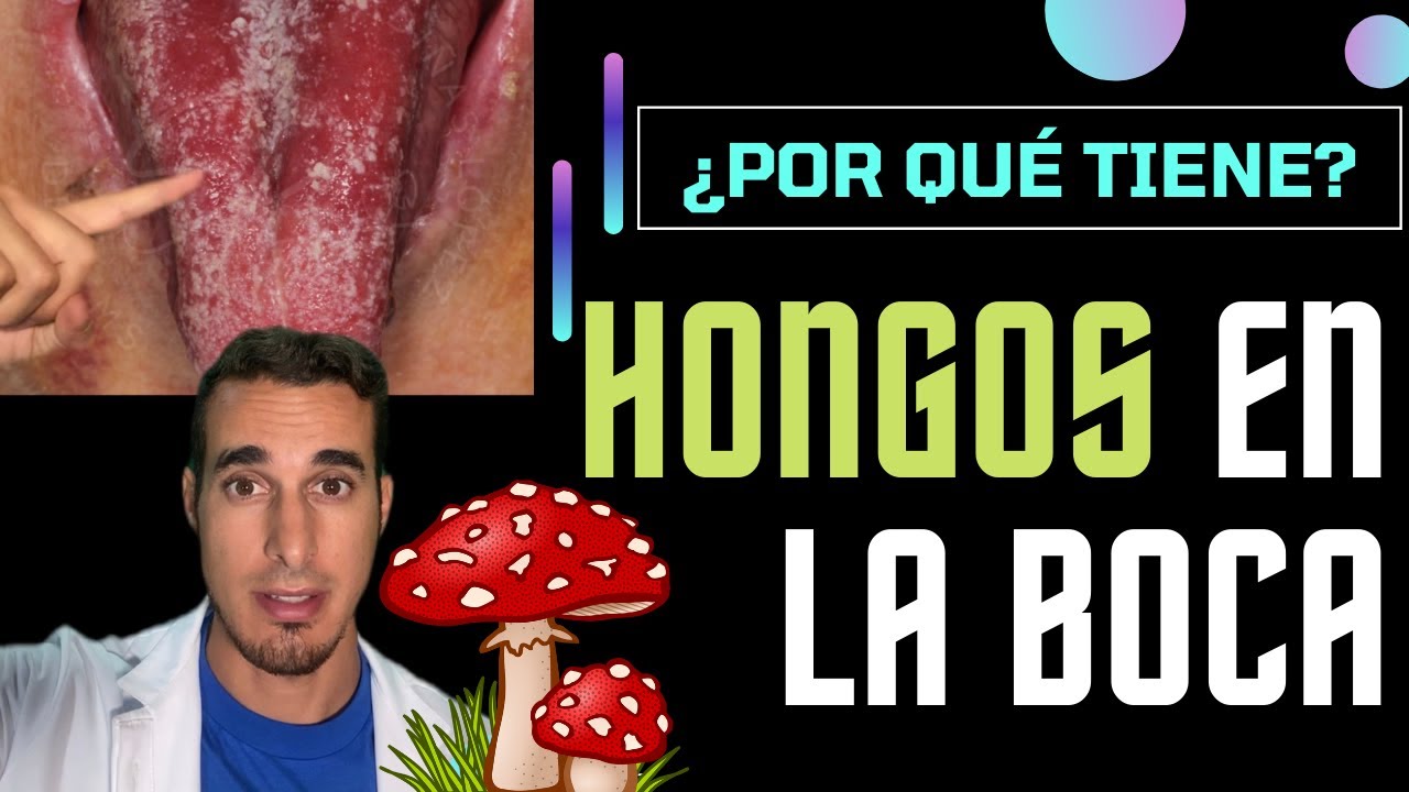 hongos en la lengua
