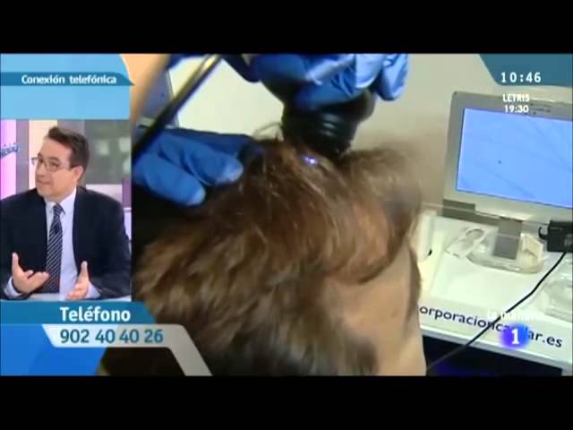 pelo fino hombre alopecia