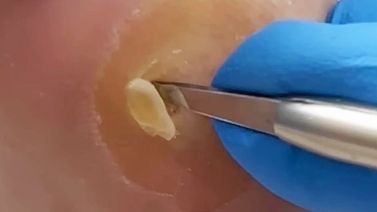 quitar clavos pie
