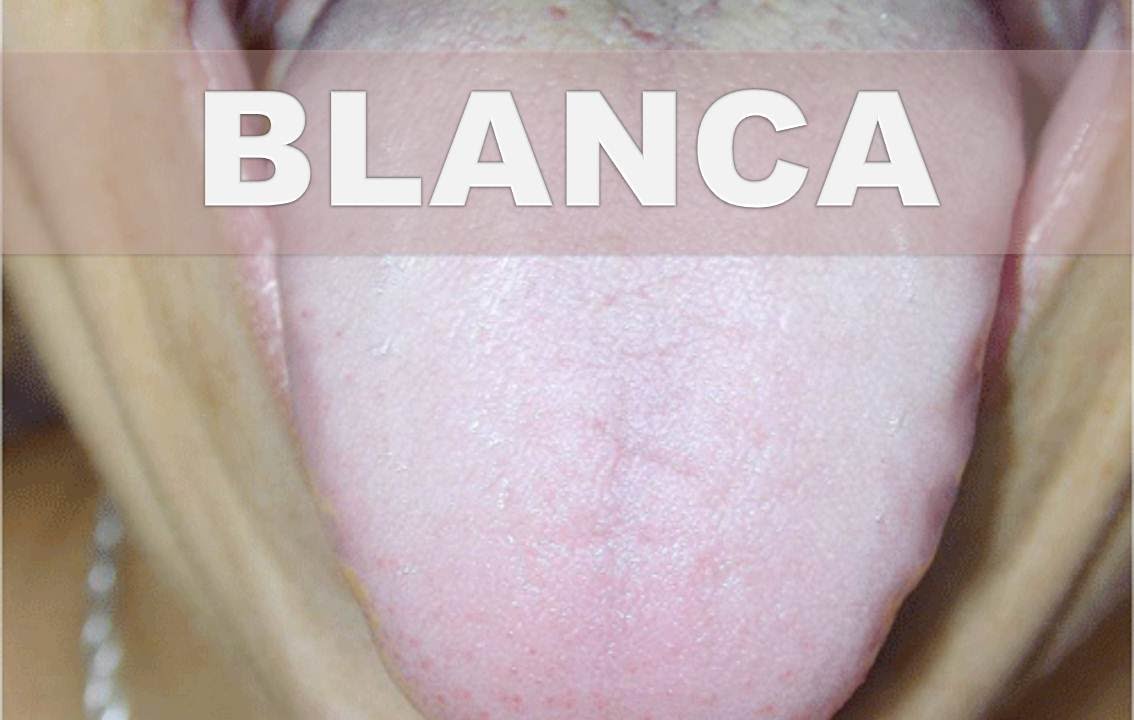 remedios caseros para limpiar la lengua
