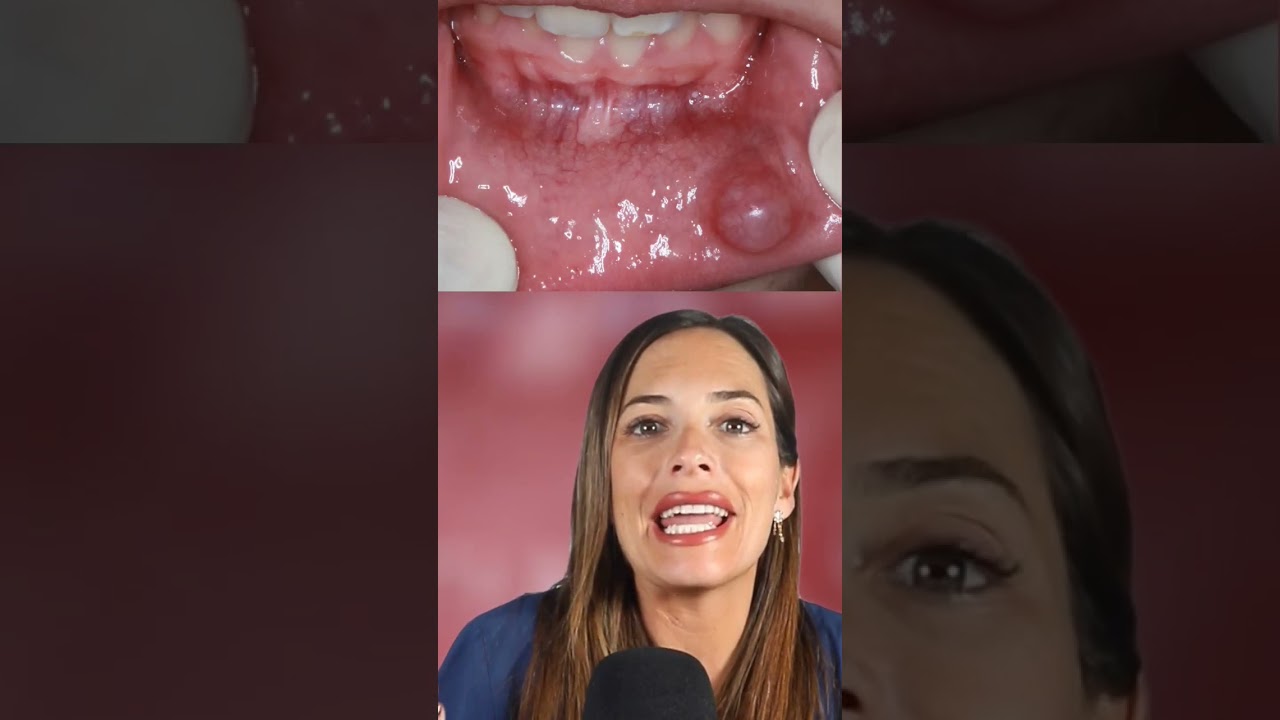 bulto interior labio