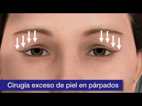 clinica baviera operacion de parpados