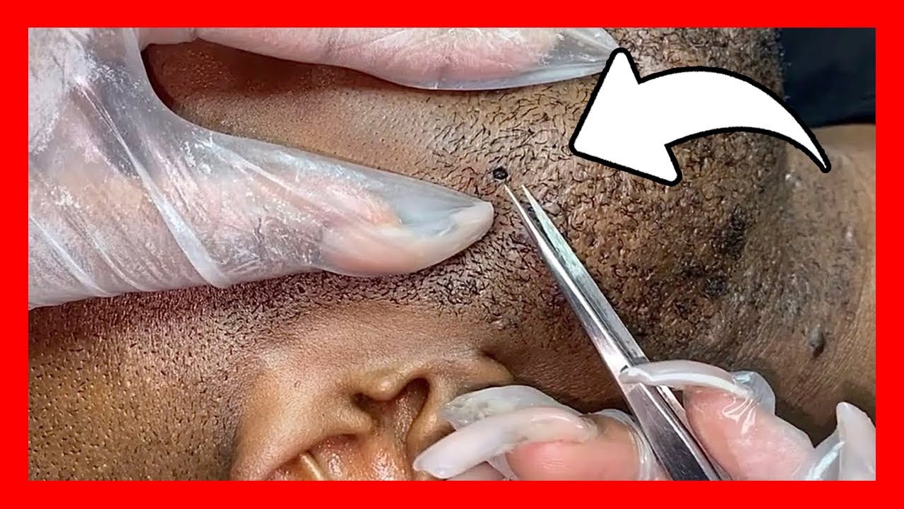 grano pelo enquistado ingle
