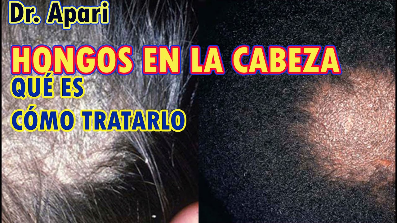 hongos en la cabeza