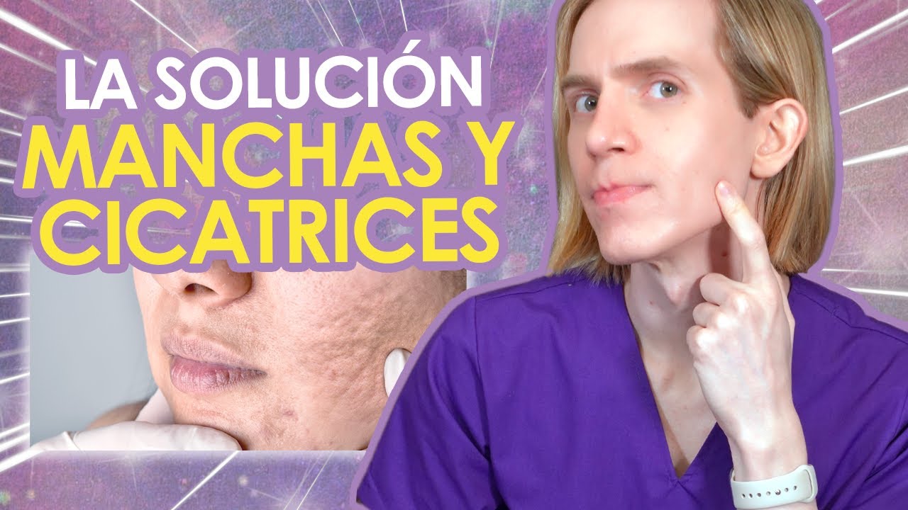 pomada para cicatrices de acne