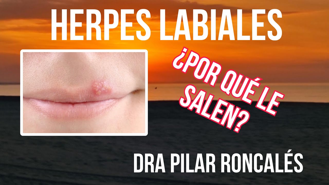 porque sale calentura labial